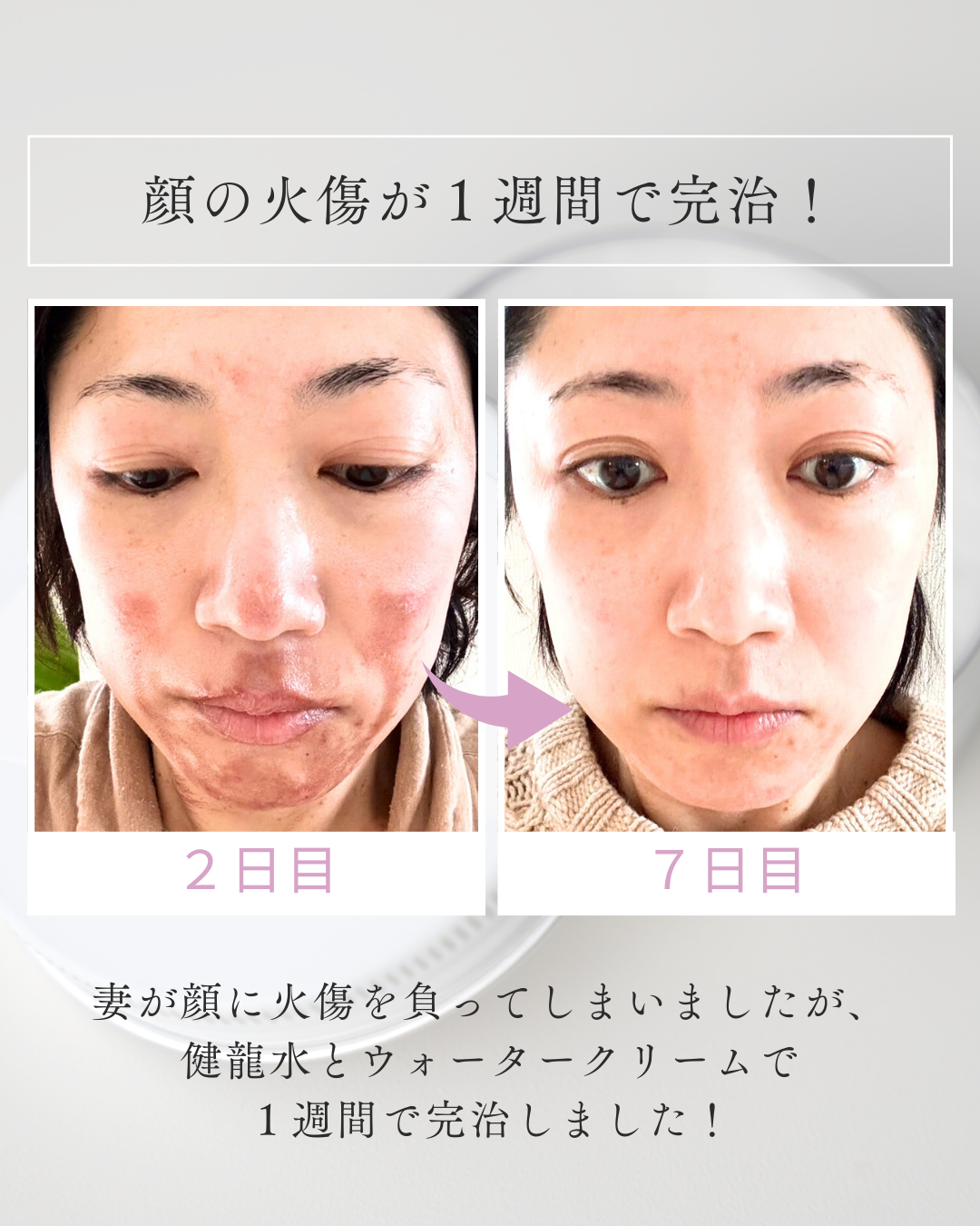 妻の火傷が１週間で完治した奇跡のような話です。